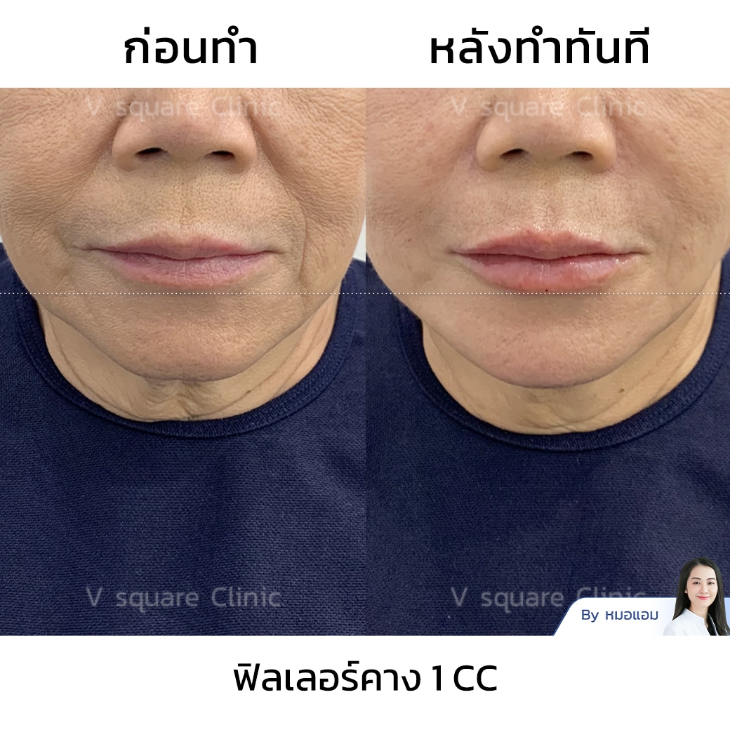 รีวิวฟิลเลอร์คาง