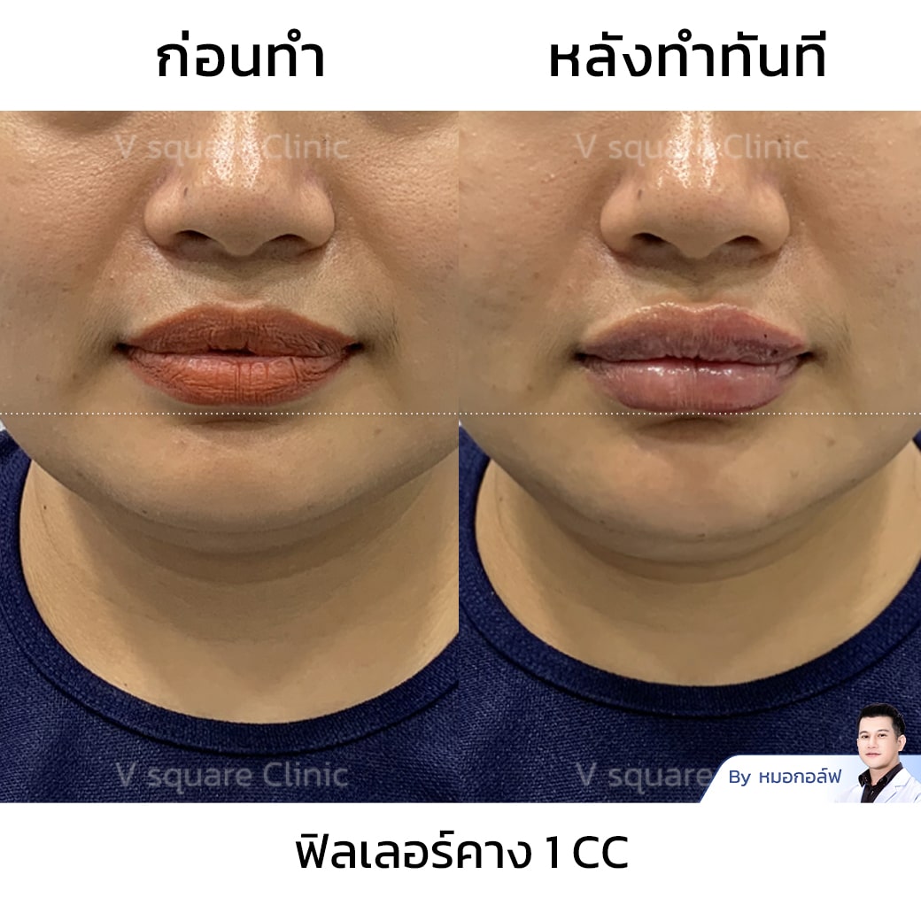 รีวิวฟิลเลอร์คาง