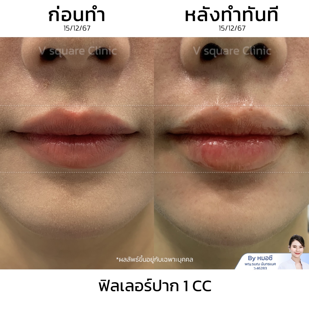 รีวิวฟิลเลอร์ปาก