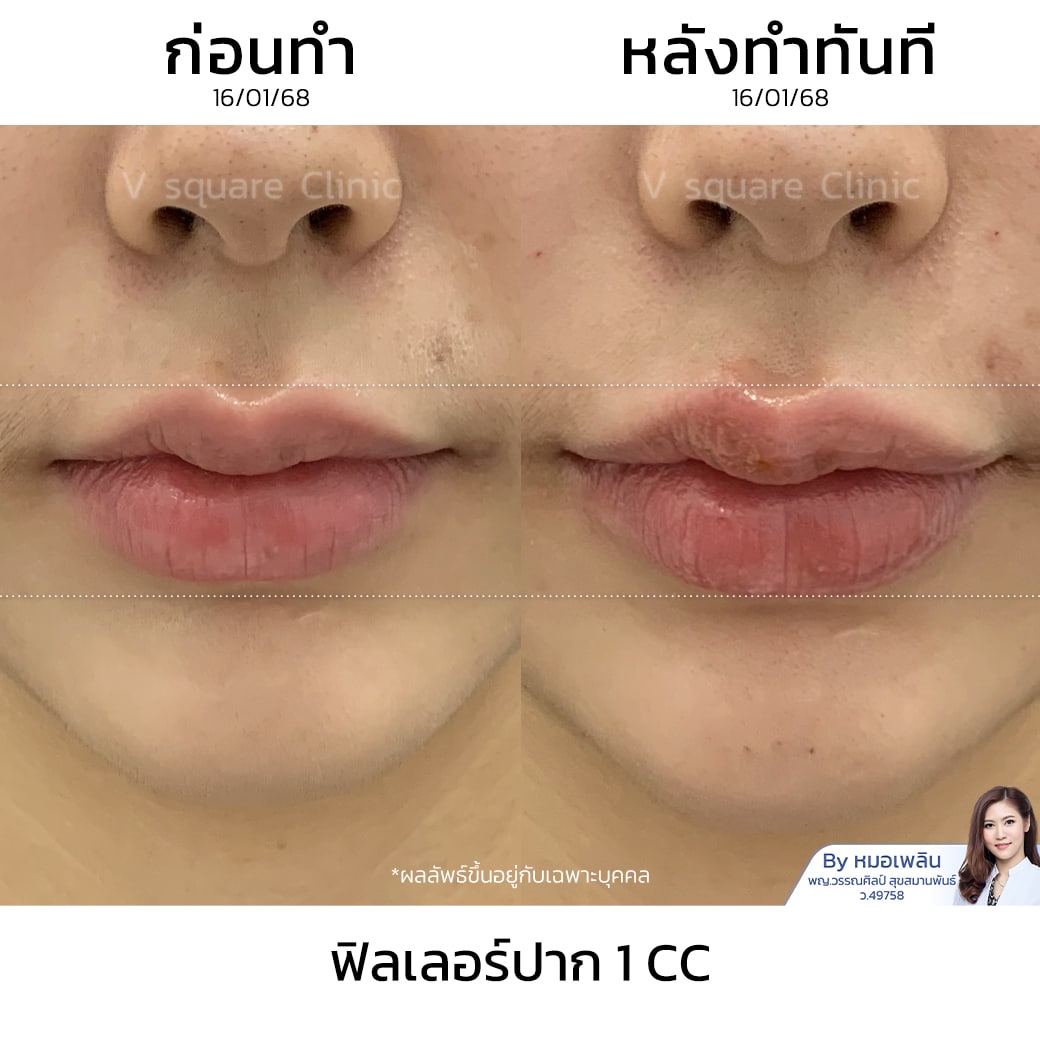 รีวิวฟิลเลอร์ปาก