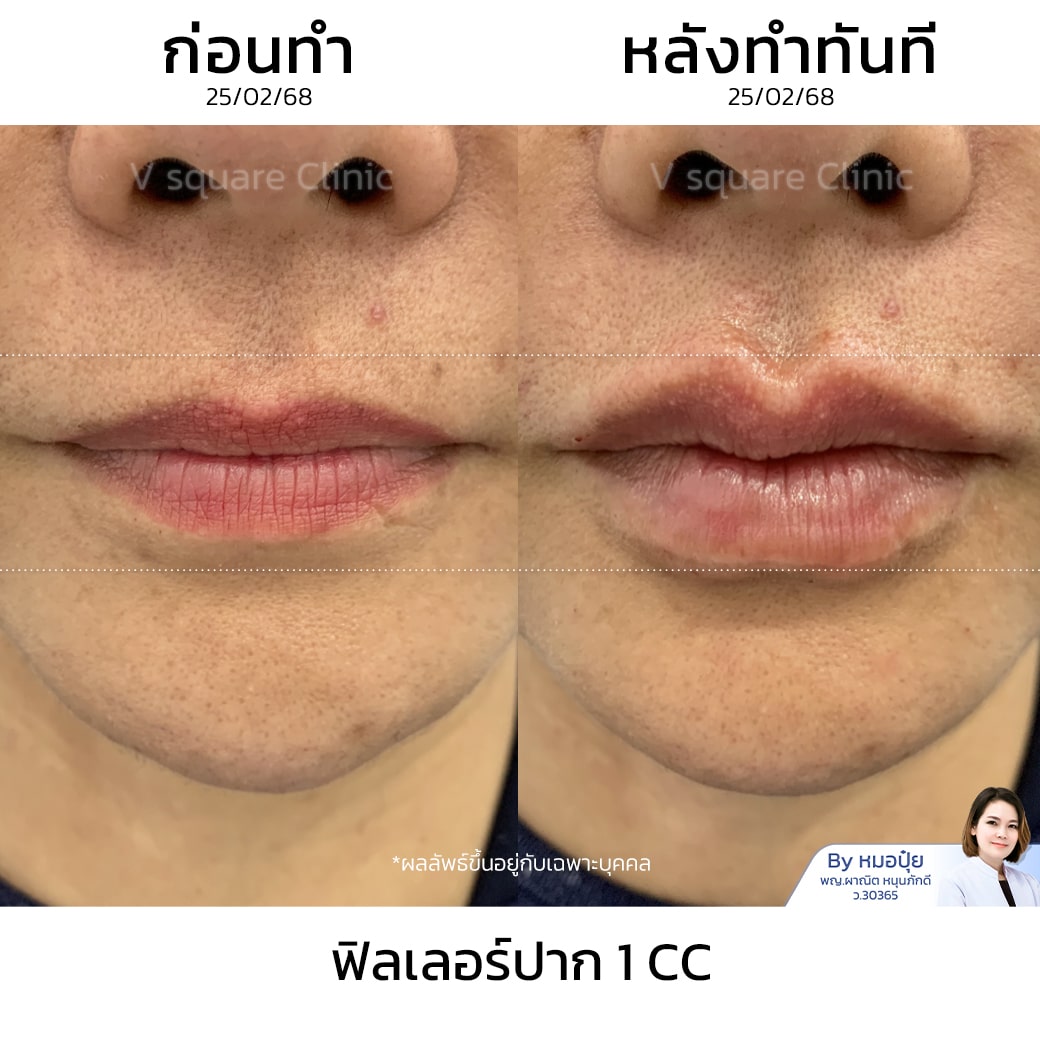 รีวิวฟิลเลอร์ปาก