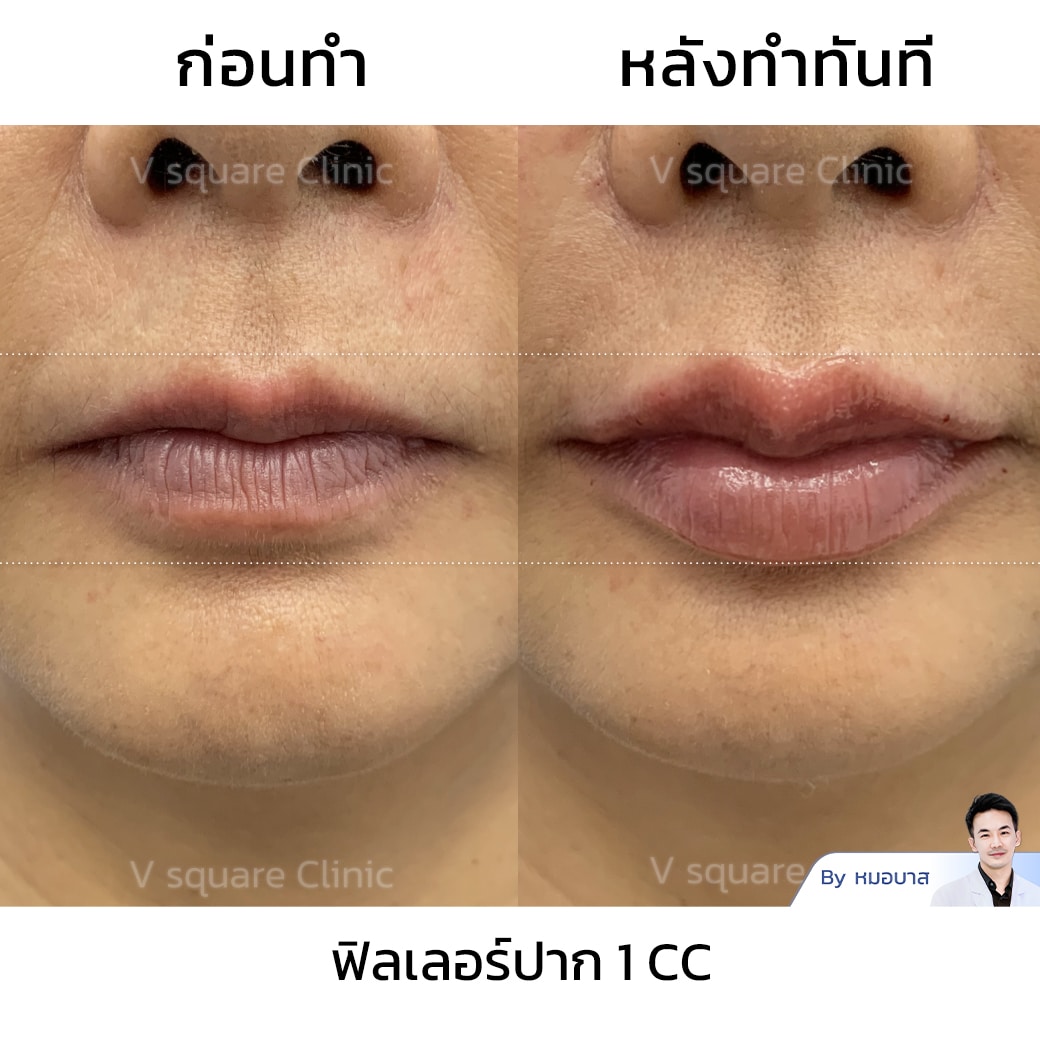 รีวิวฟิลเลอร์ปาก