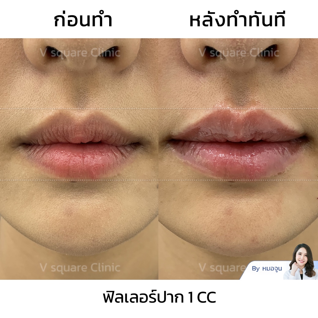 รีวิวฟิลเลอร์ปาก