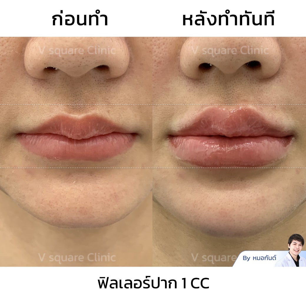 รีวิวฟิลเลอร์ปาก