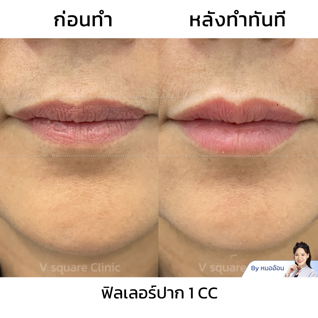 รีวิวฟิลเลอร์ปาก