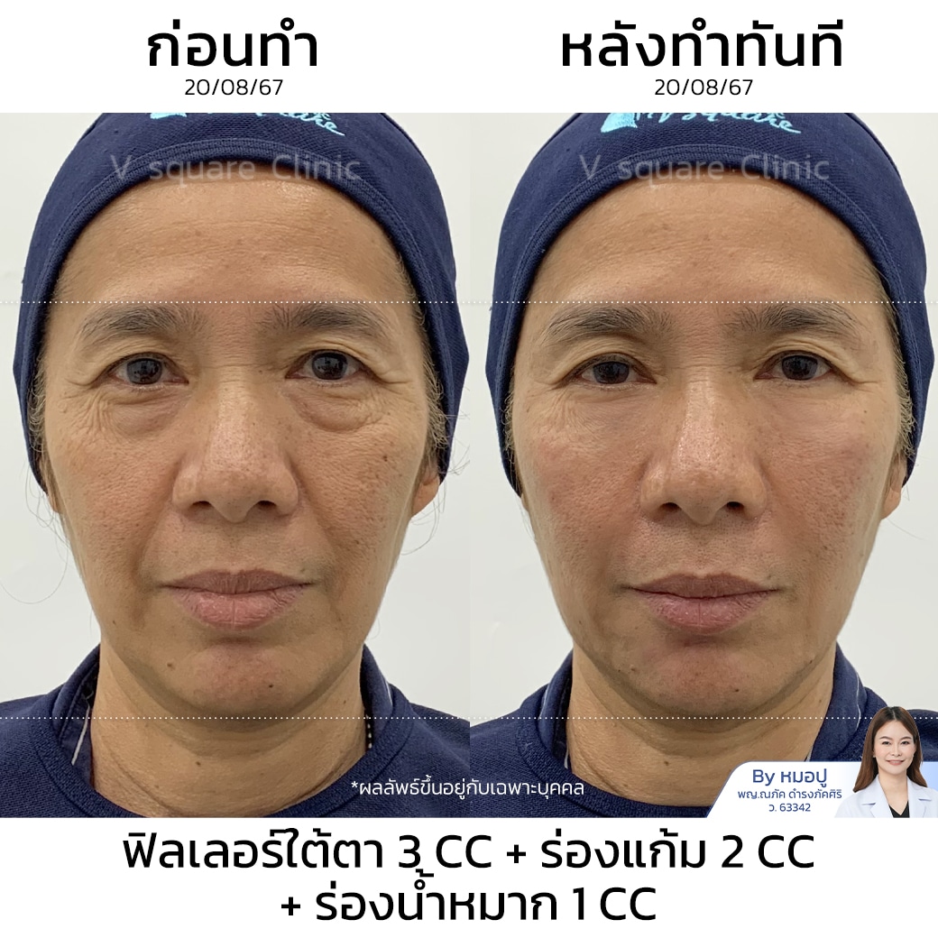 รีวิวฟิลเลอร์ร่องแก้ม