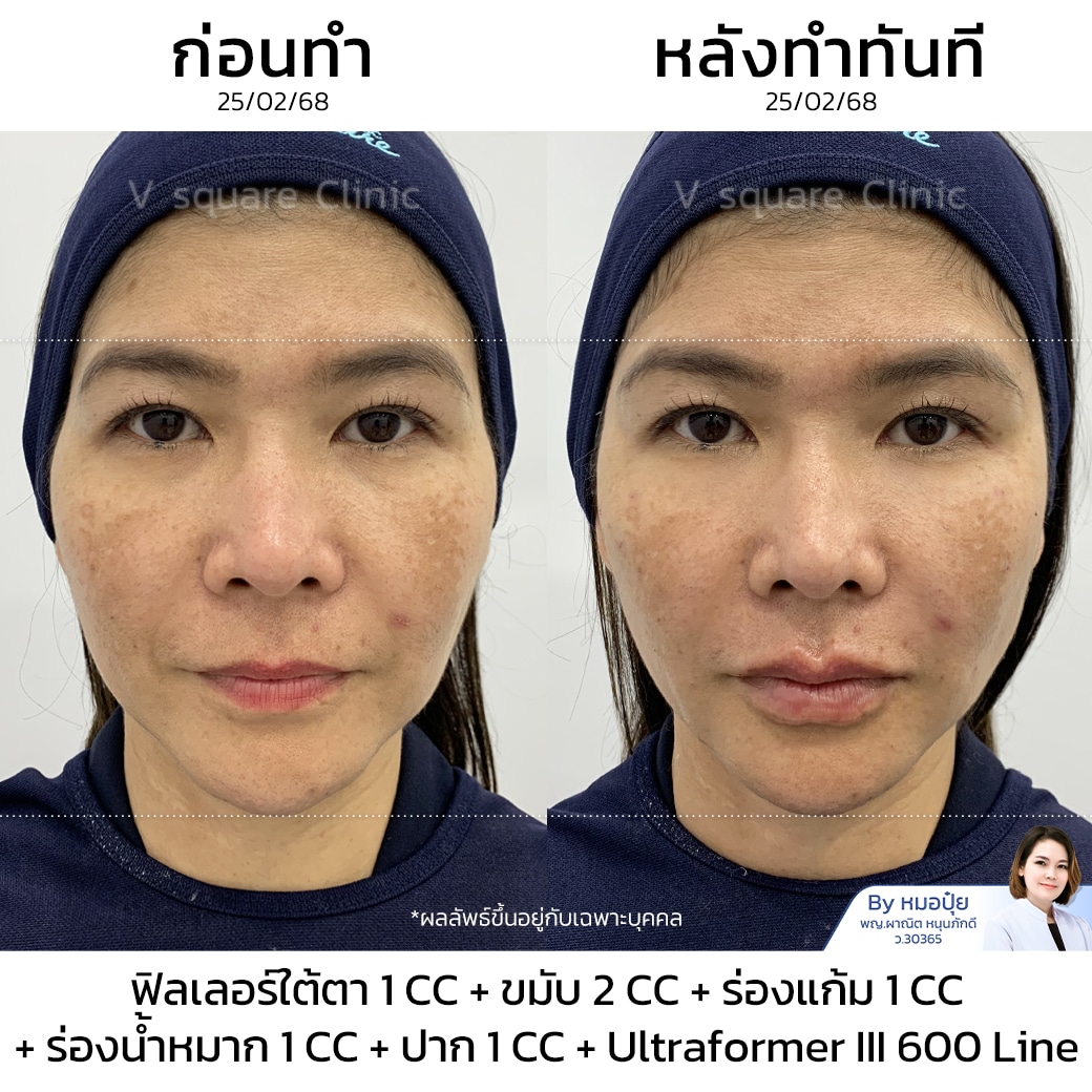 รีวิวฟิลเลอร์ร่องแก้ม