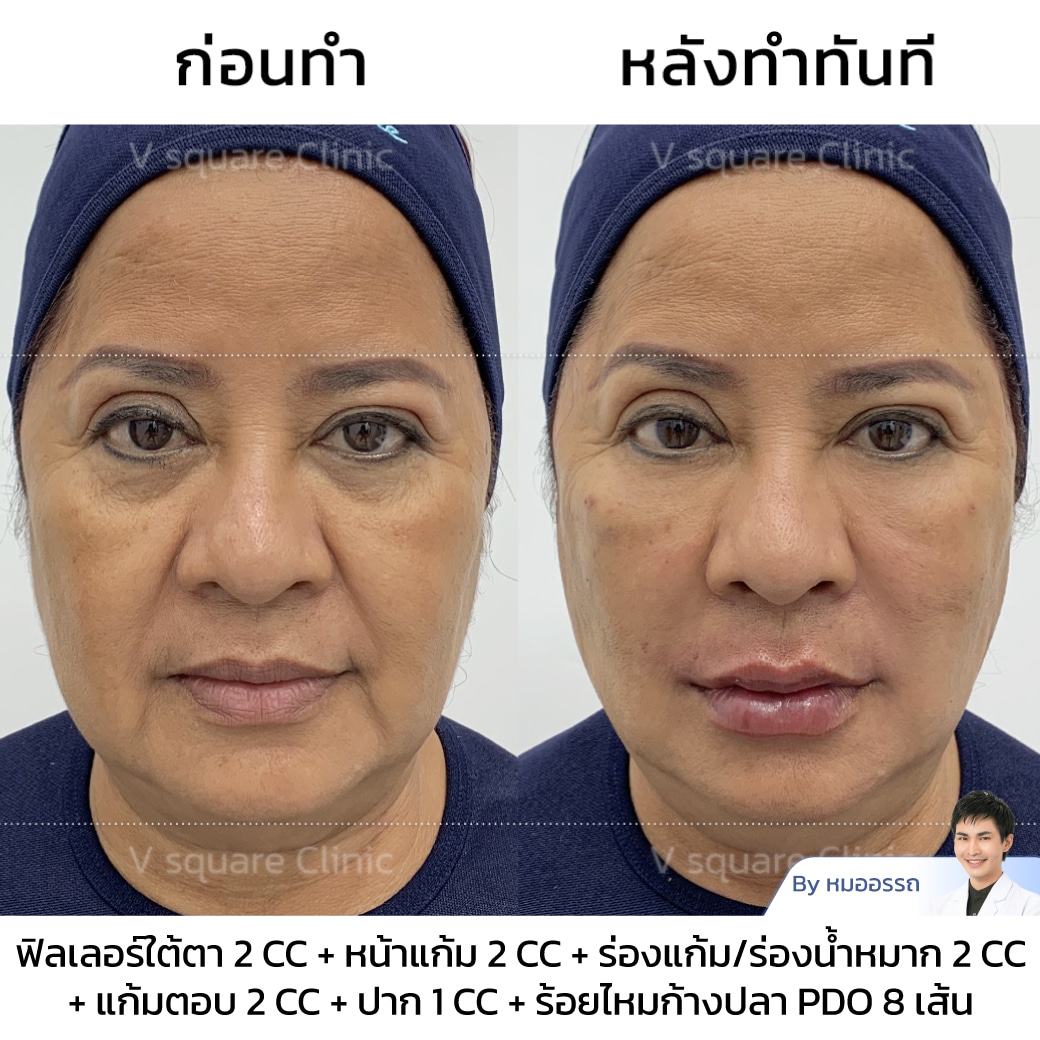 รีวิวฟิลเลอร์ร่องแก้ม