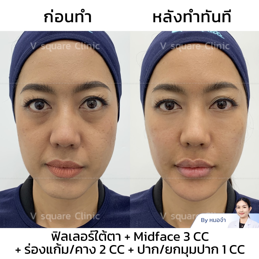 รีวิวฟิลเลอร์ร่องแก้ม