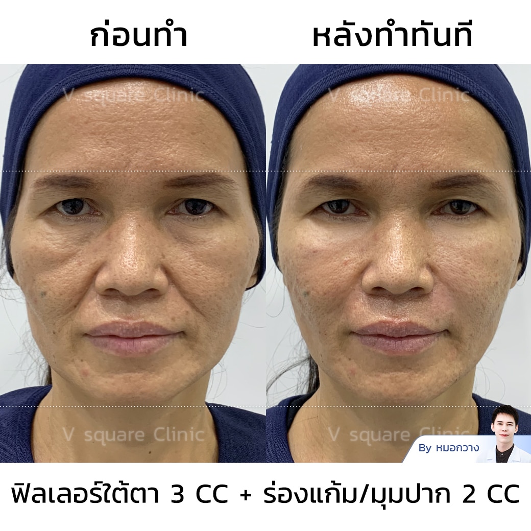 รีวิวฟิลเลอร์ร่องแก้ม