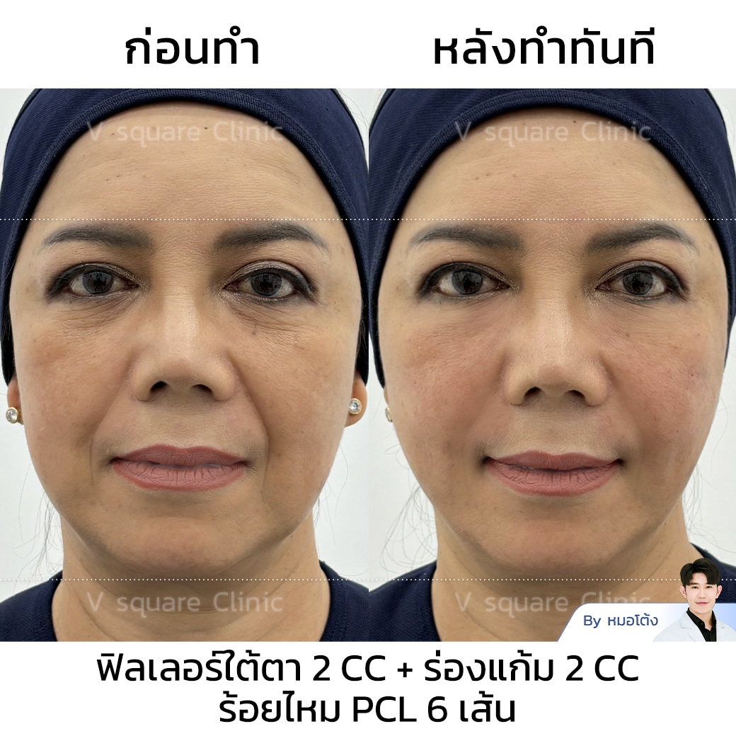 รีวิวฟิลเลอร์ร่องแก้ม