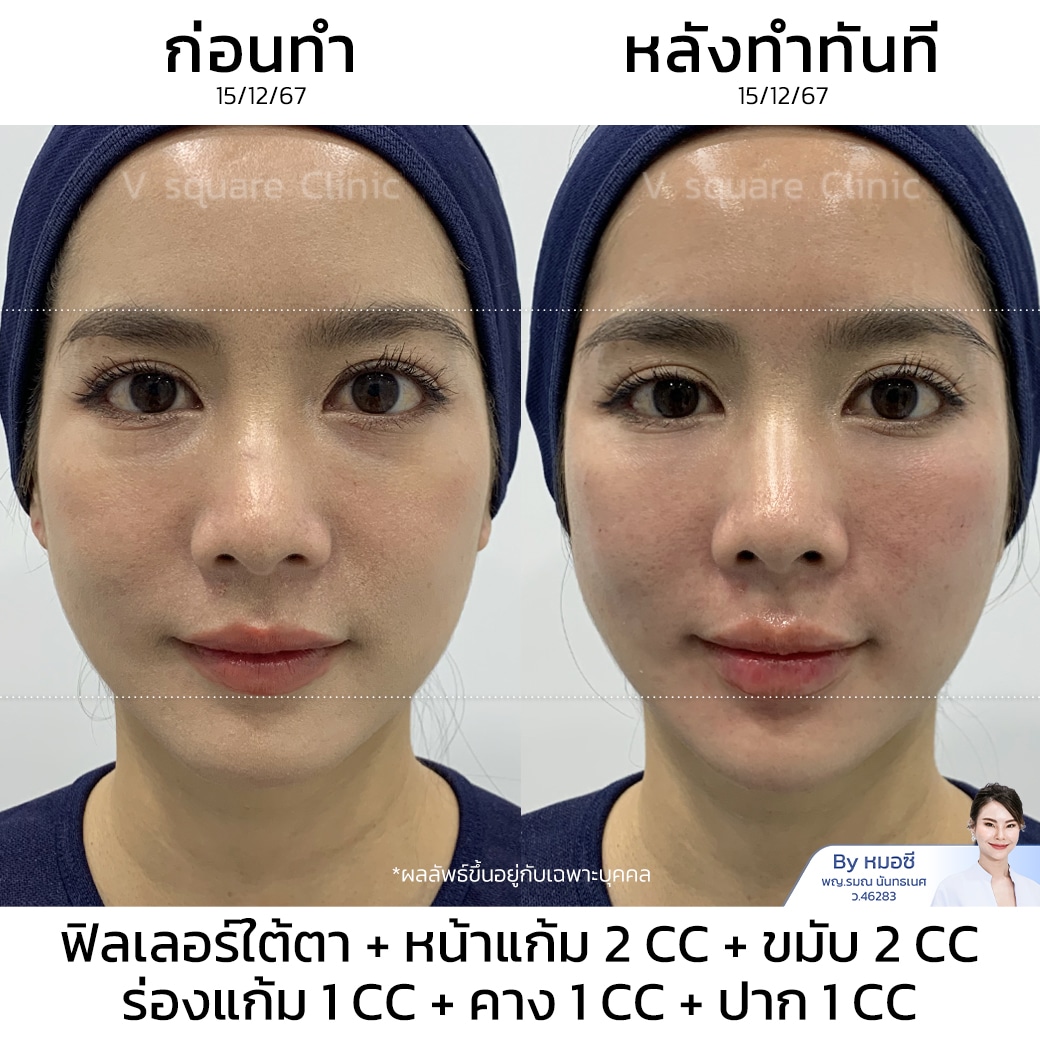 รีวิวฟิลเลอร์ใต้ตา