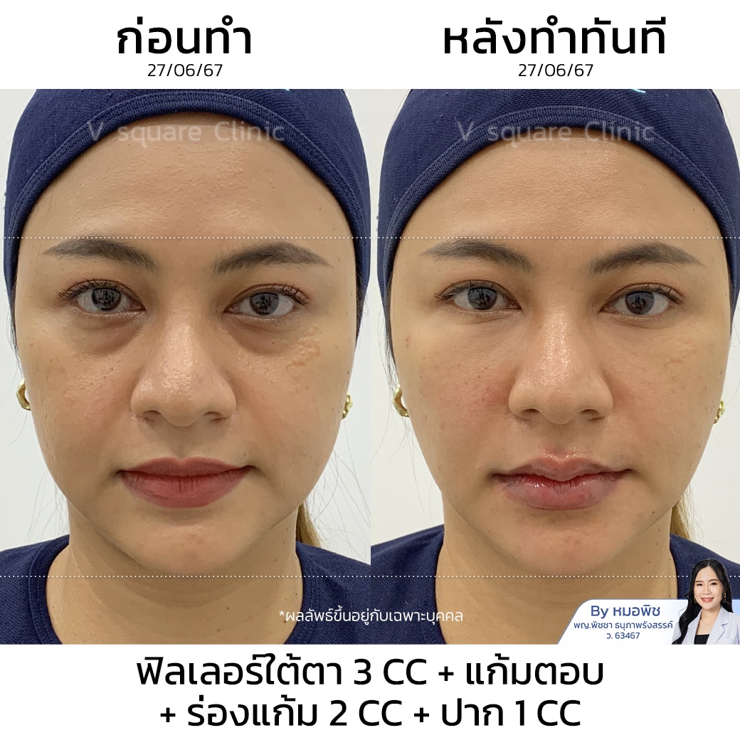 รีวิวฟิลเลอร์ใต้ตา