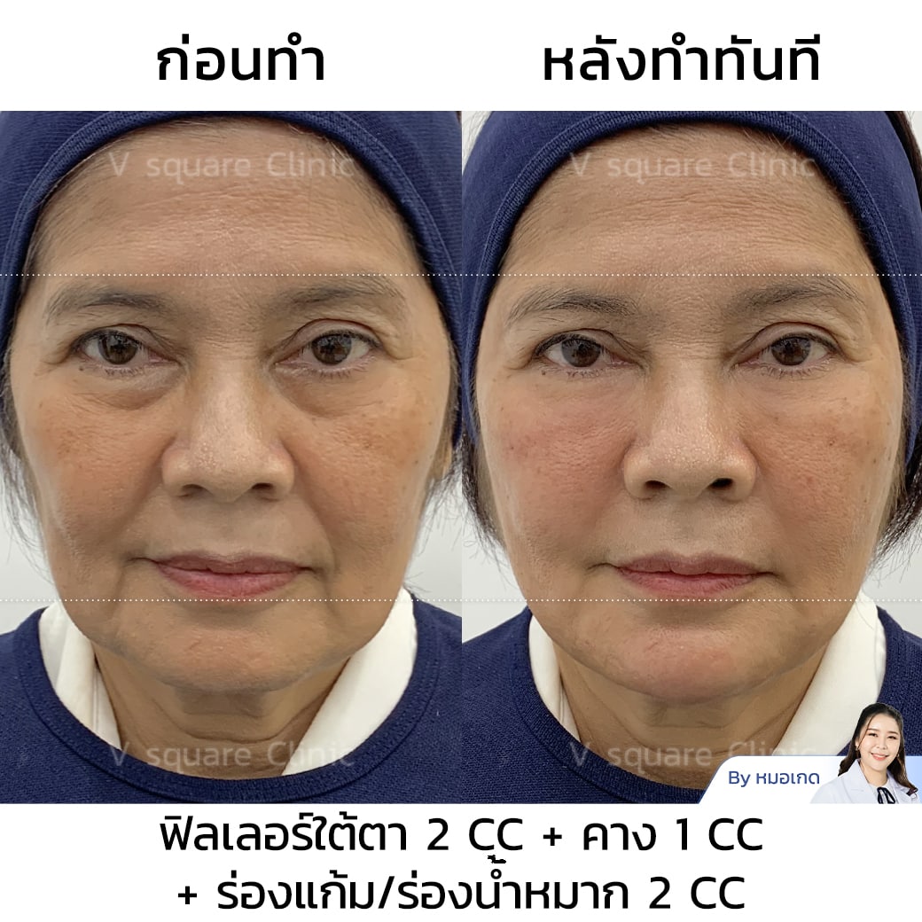 รีวิวฟิลเลอร์ใต้ตา