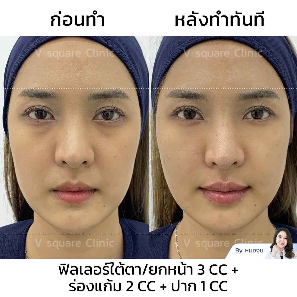 รีวิวฟิลเลอร์ใต้ตา