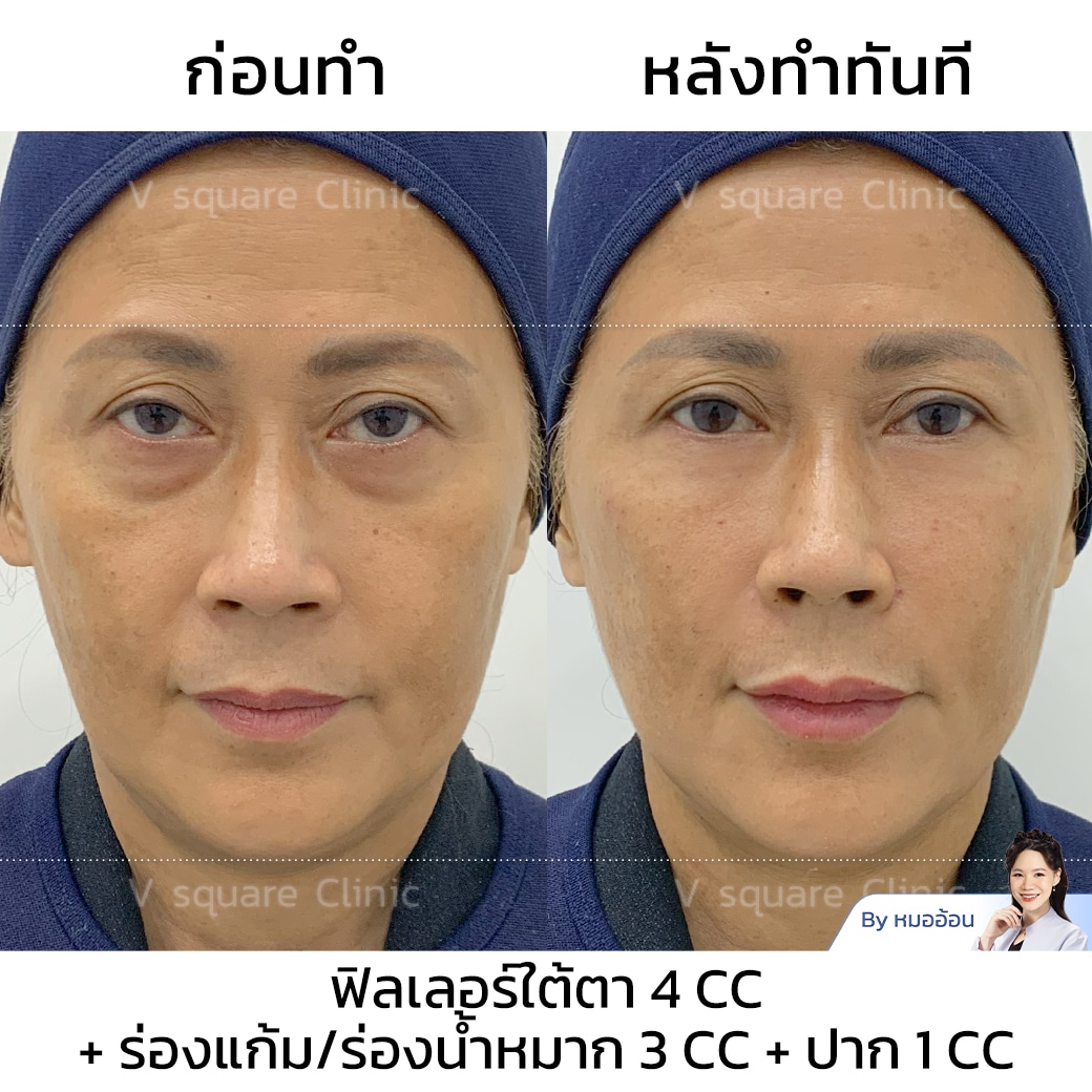รีวิวฟิลเลอร์ใต้ตา