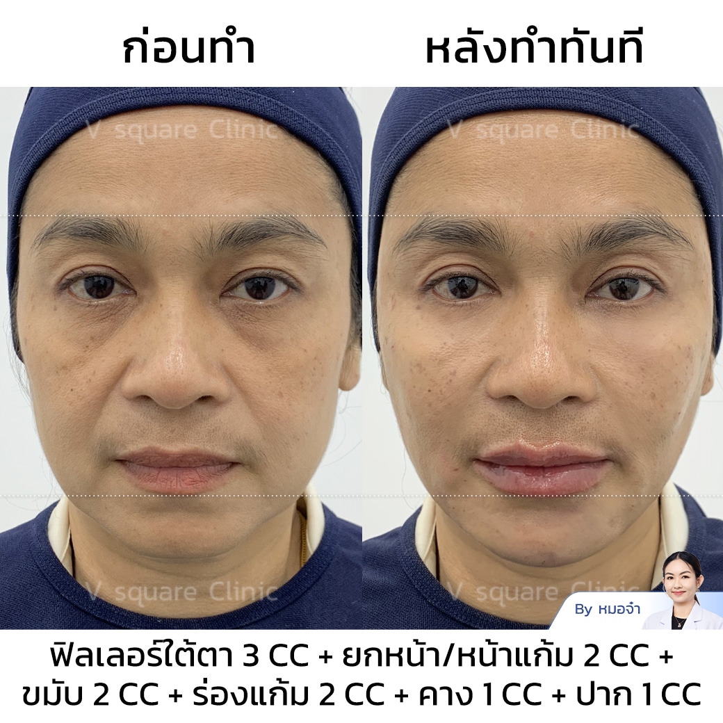 รีวิวฟิลเลอร์ใต้ตา