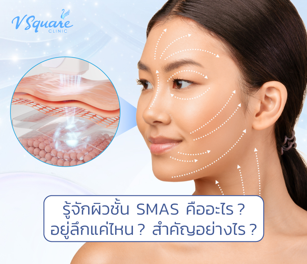 SMAS