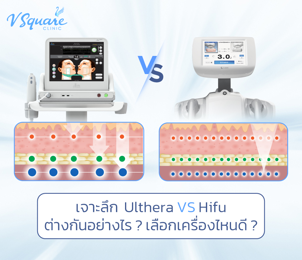 ulthera vs hifu