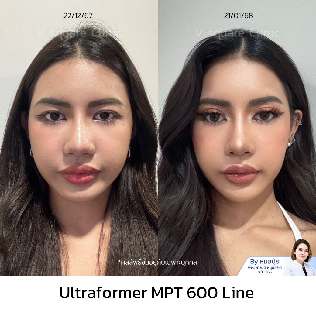 รีวิว hifu_บินนี่