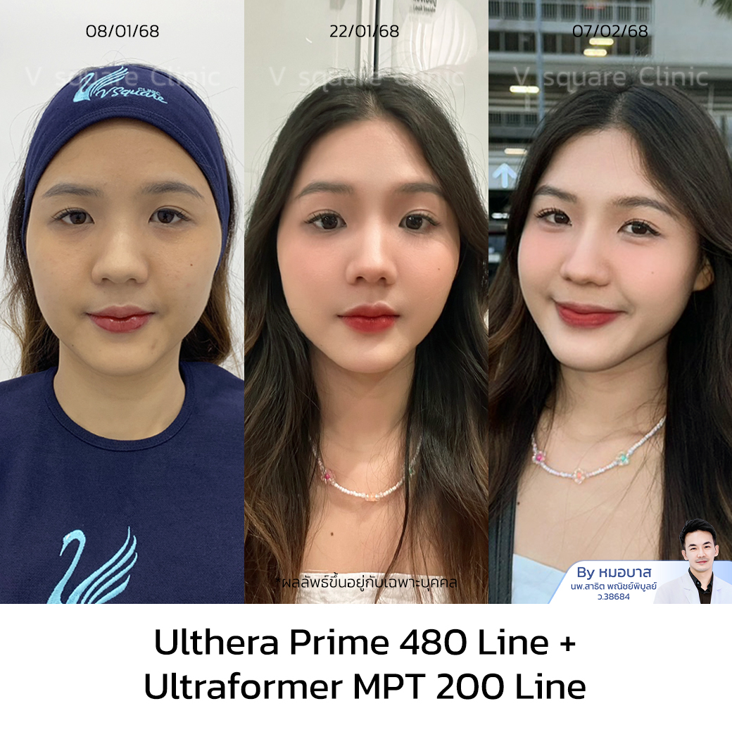 รีวิวผลลัพธ์ Ulthera อยู่ได้นานไหม เอิร์น UL RR+MPT