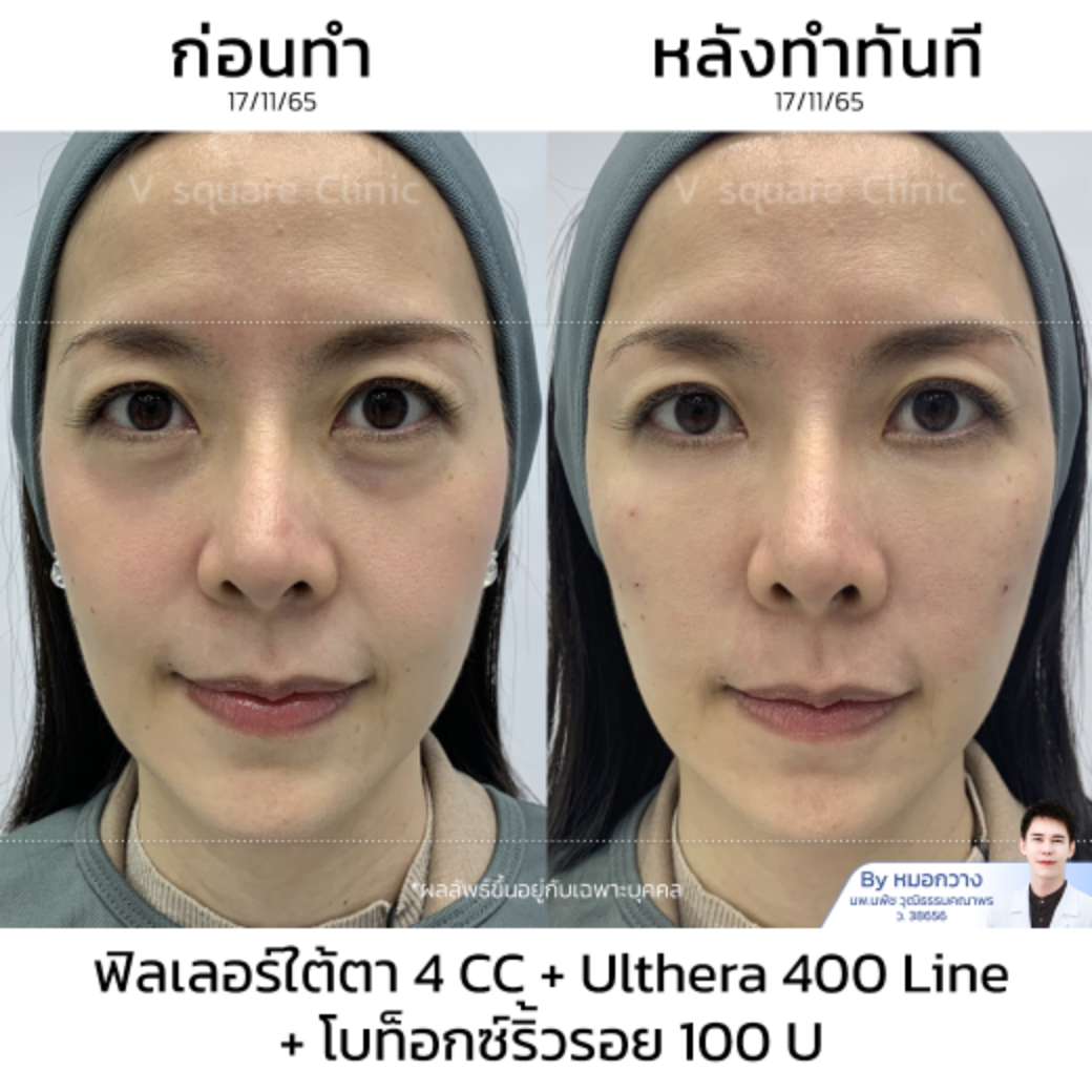 Ulthera รีวิว_คุณบิ๊ว