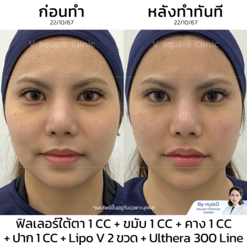 Ulthera รีวิว_น้องเตย