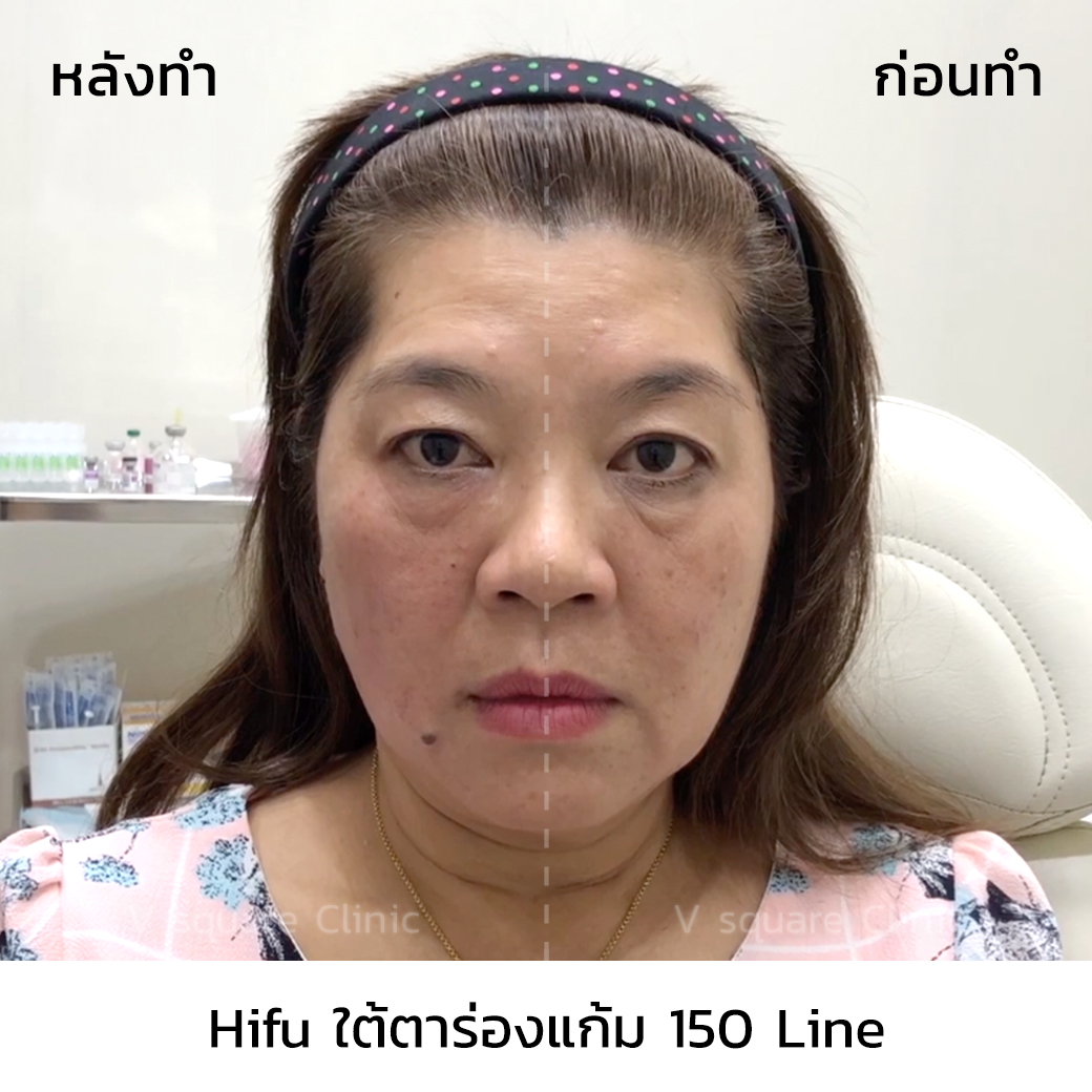 รีวิว Ultraformer III_แอน