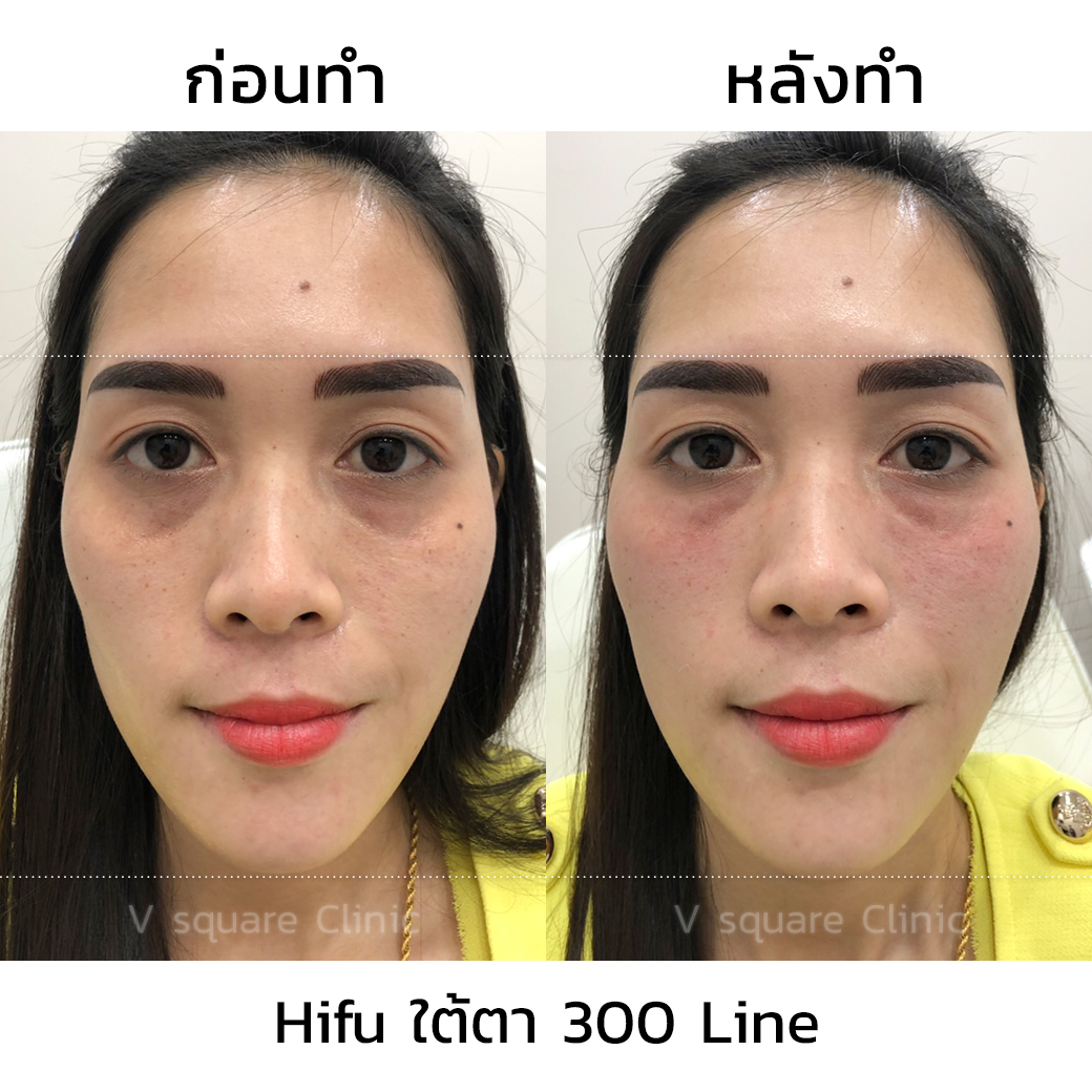 รีวิว Ultraformer III_โต้ง
