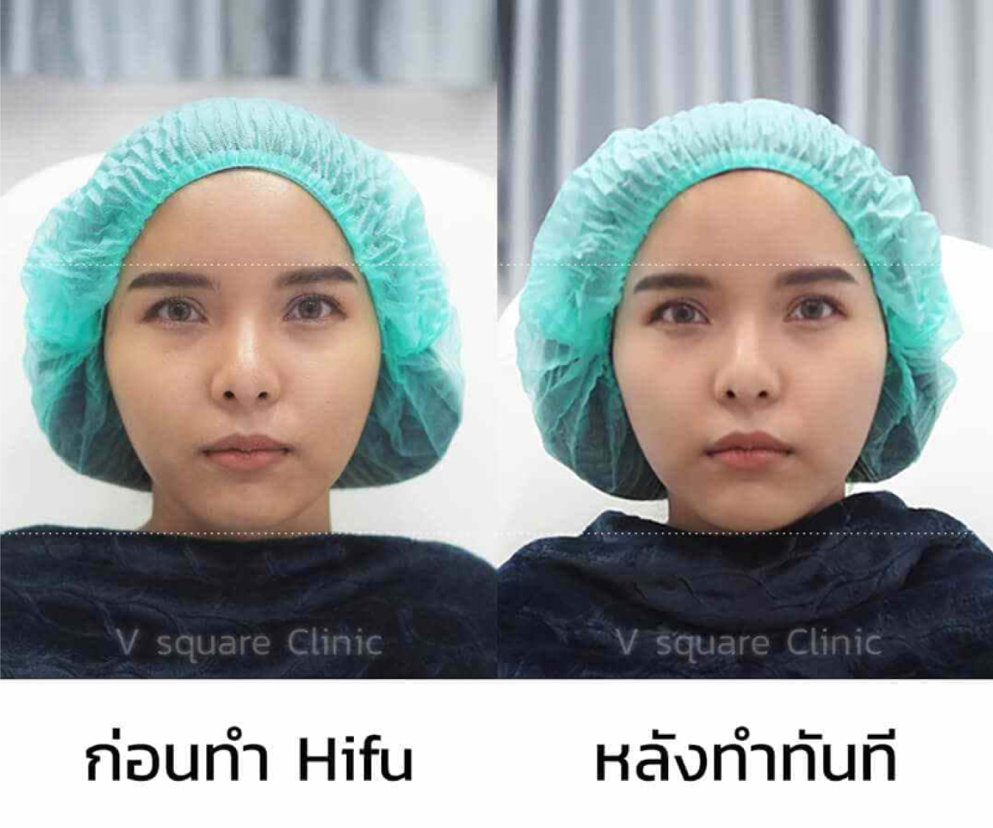 รีวิว Ultraformer III_ไวท์