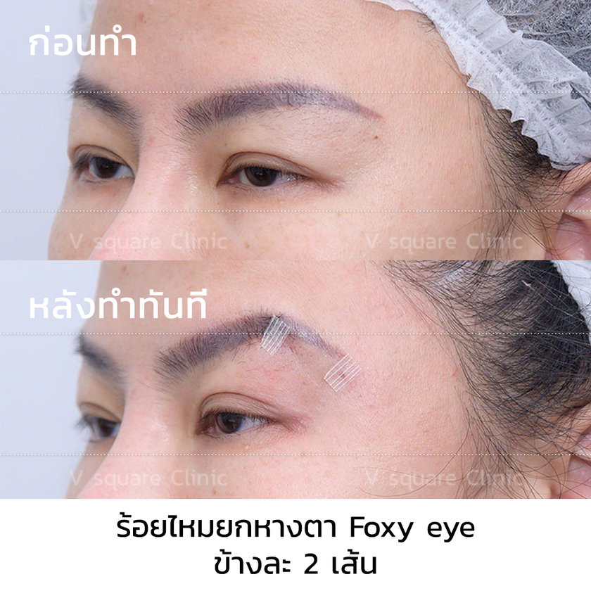 รีวิว ร้อยไหมยกหางตา Foxy Eye