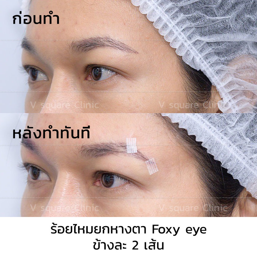 รีวิว ร้อยไหมยกหางตา
