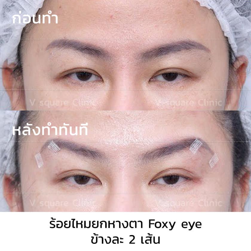 ร้อยไหมยกหางตา Foxy Eye รีวิว
