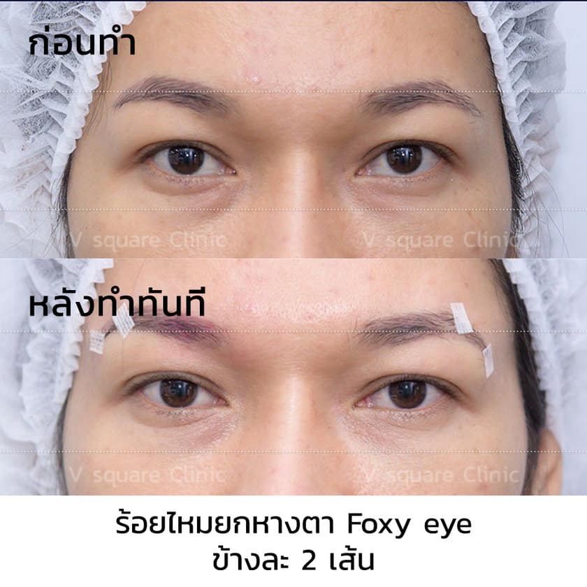 ร้อยไหมยกหางตา รีวิว