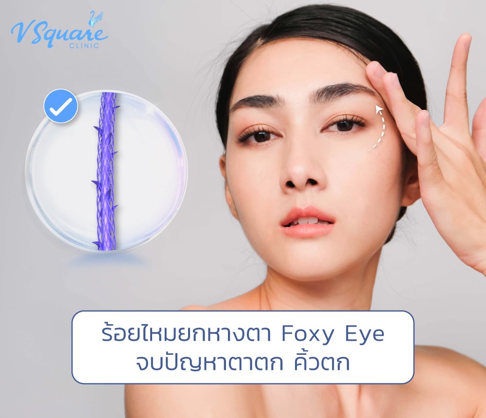 ร้อยไหมยกหางตา