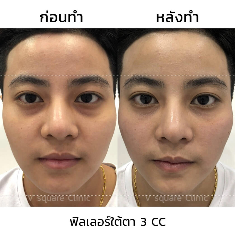 2.รีวิวฟิลเลอร์ใต้ตา
