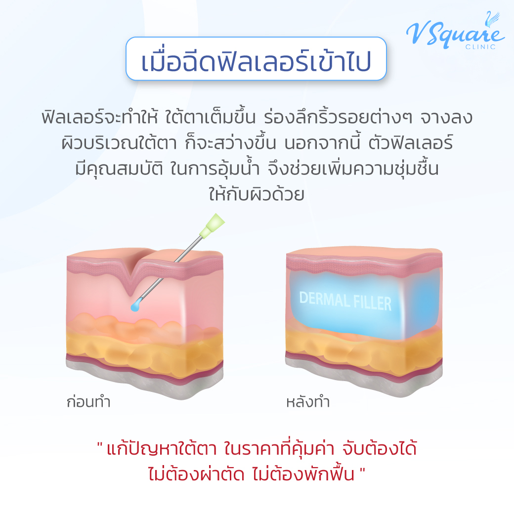 ฟิลเลอร์ใต้ตา