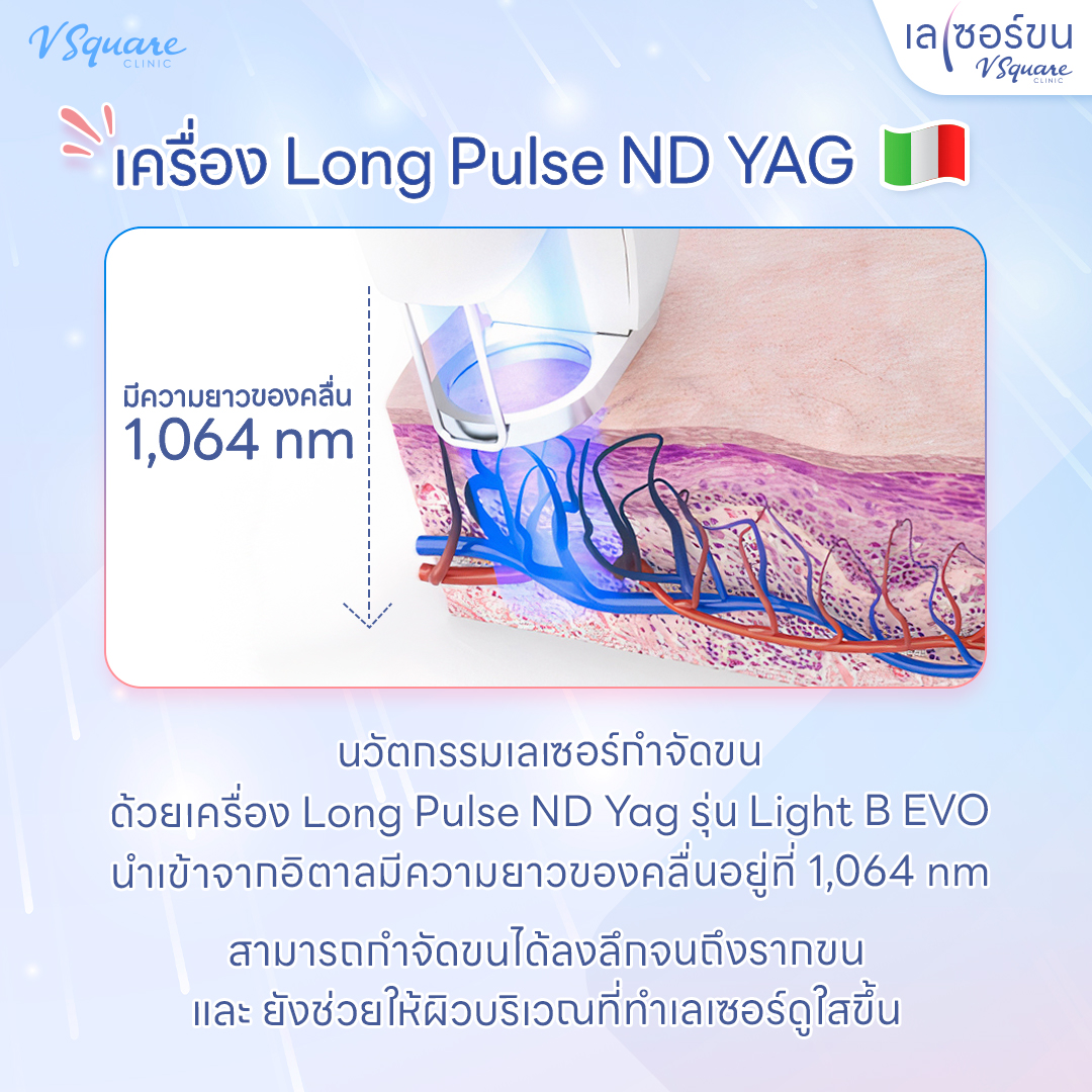 YAG Laser ทำงานยังไง