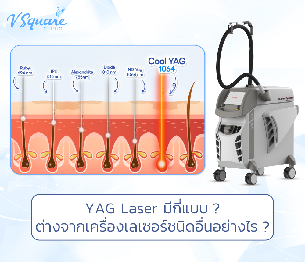 YAG Laser