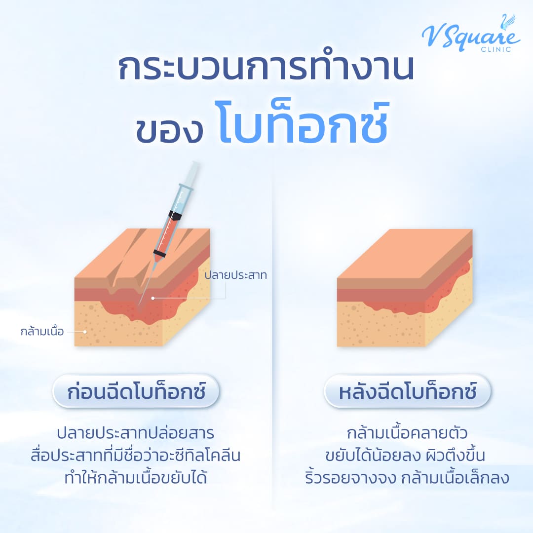 กระบวนการออกฤทธิ์ของโบท็อก Bienox