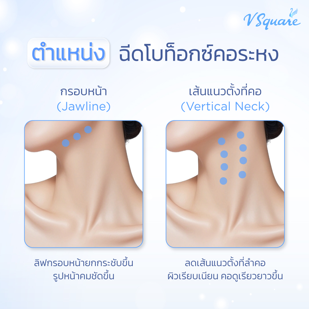 จุดฉีดโบท็อกบ่าคอระหง