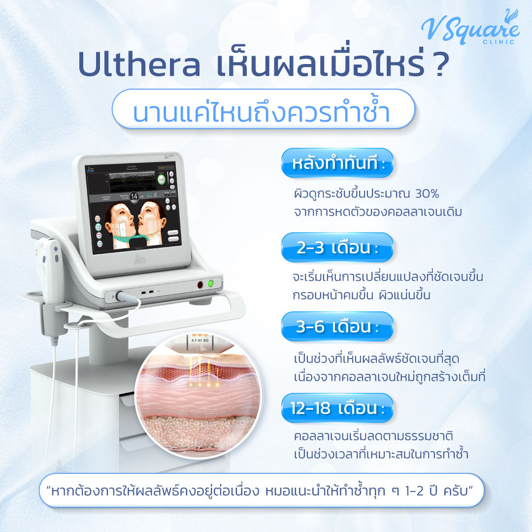 Ulthera กี่วันเห็นผล