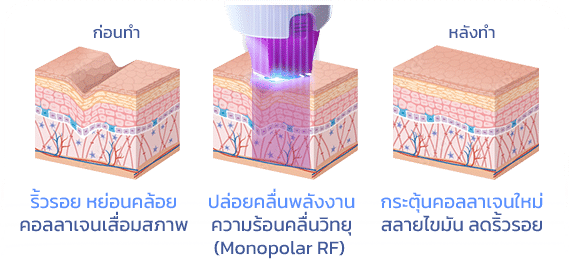 กระบวนการทำงาน Thermage