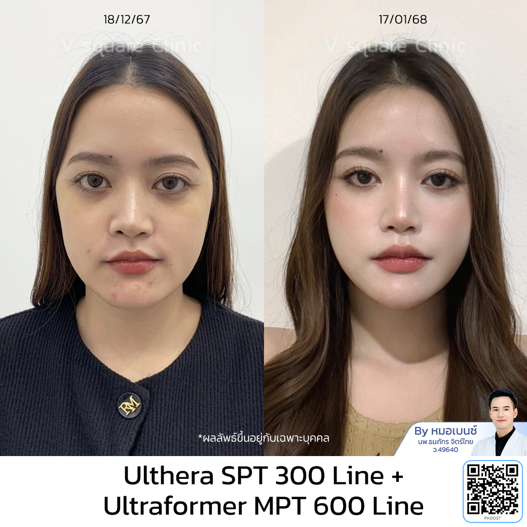 รีวิว Ulthera_คุณเฟรนด์ โดย หมอเบนซ์