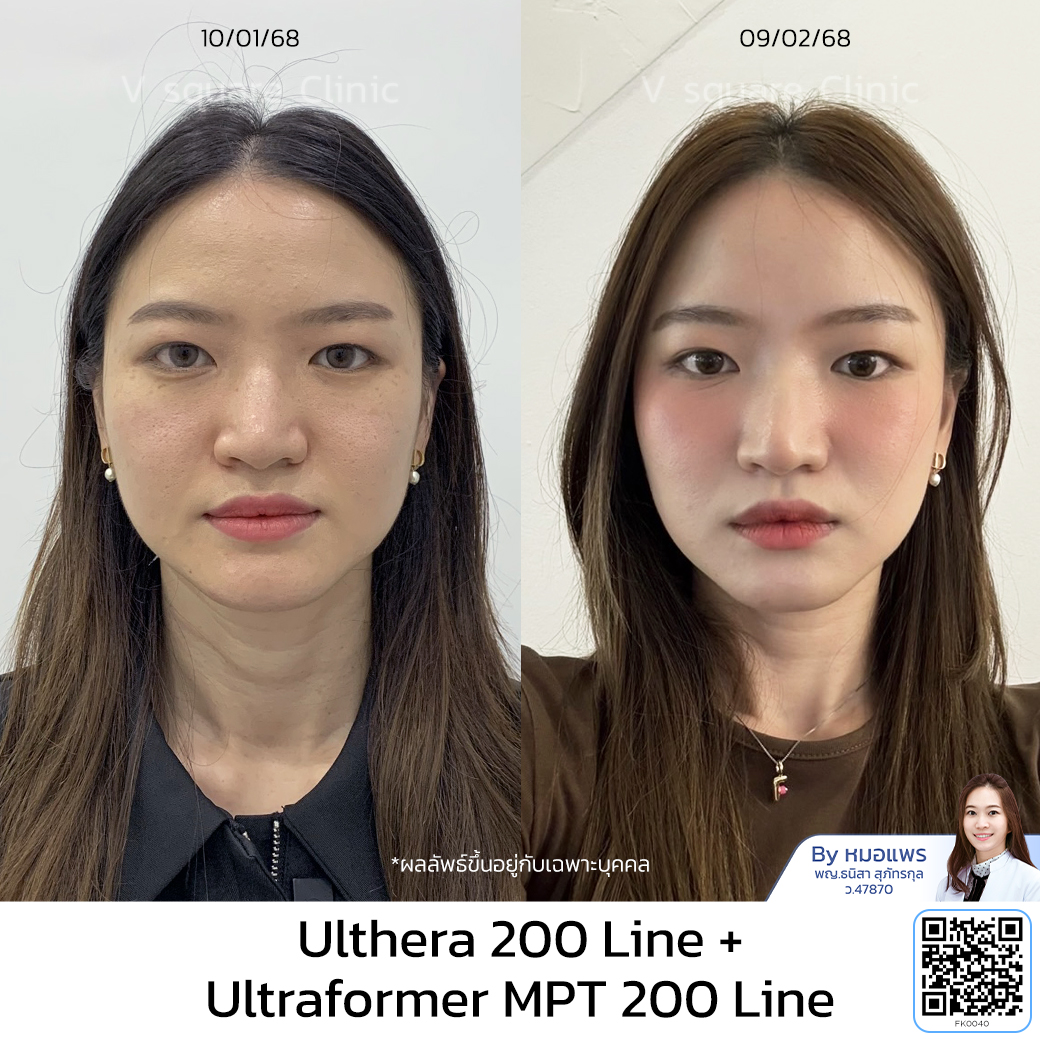 รีวิว Ulthera_ฟิว โดย หมอ แพร