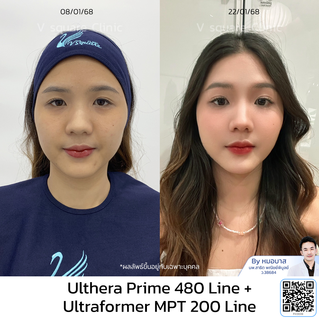 รีวิว Ulthera_เอิร์น โดย หมอ บาส