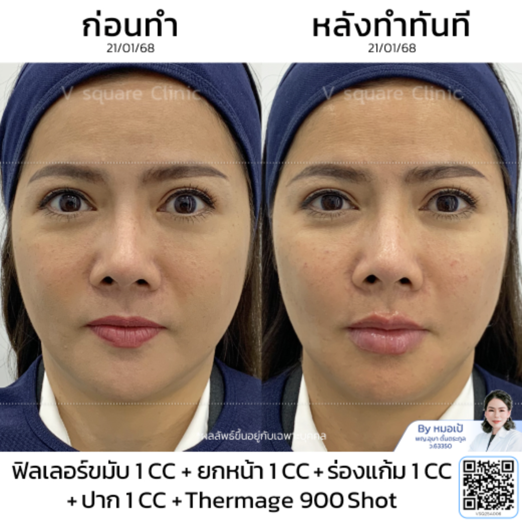 รีวิวหลังทำ Thermage_พี่ปุ้ย by หมอเป้