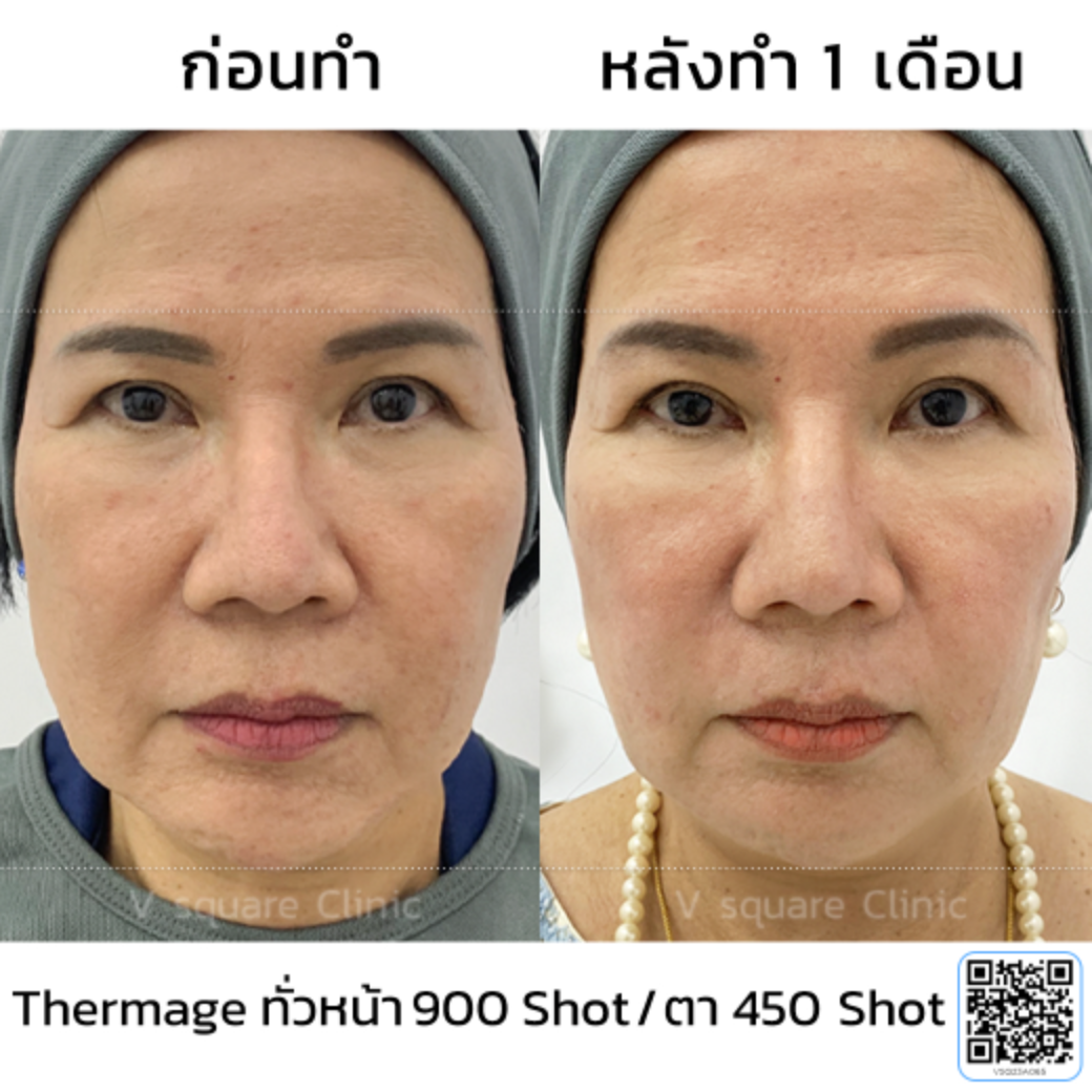 รีวิวหลังทำ Thermage_แม่อ๋อย
