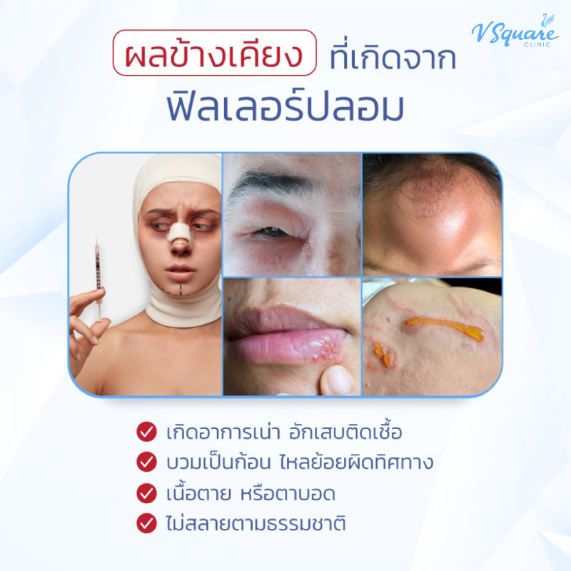 อาการแบบไหนต้องขูดฟิลเลอร์ออก